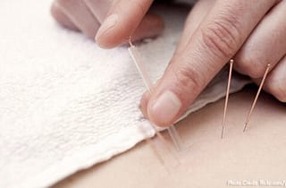 Benefits of Acupuncture